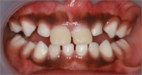 Intra-oral picture after the application of anterior direct anterior tracks on the day
