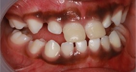 Intra-oral picture after the application of anterior direct anterior tracks on the day