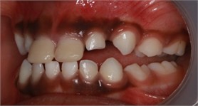 Intra-oral picture after the application of anterior direct anterior tracks on the day