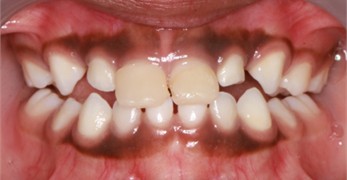 a)-c) Follow-up pictures on day 13, d)-g) Follow-up pictures after 3 months