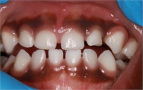 Sibling 1’s initial pictures: a) anterior view in maximum intercuspidation, b) manipulated position of the mandible, c) right-side view, d) left-side view, e) negative overjet