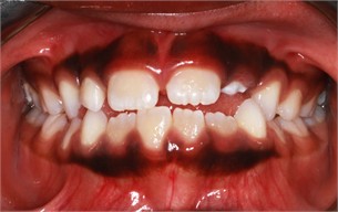 Follow-up pictures after 31 months: a)-d) intraoral pictures; e) panoramic X-ray, f)-i) facial pictures