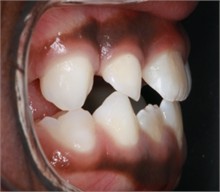 Follow-up pictures after 31 months: a)-d) intraoral pictures; e) panoramic X-ray, f)-i) facial pictures