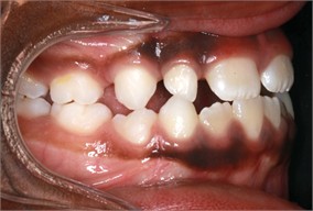 Follow-up pictures after 31 months: a)-d) intraoral pictures; e) panoramic X-ray, f)-i) facial pictures