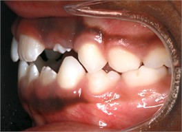 Follow-up pictures after 31 months: a)-d) intraoral pictures; e) panoramic X-ray, f)-i) facial pictures
