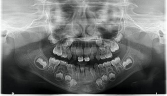 Follow-up pictures after 31 months: a)-d) intraoral pictures; e) panoramic X-ray, f)-i) facial pictures