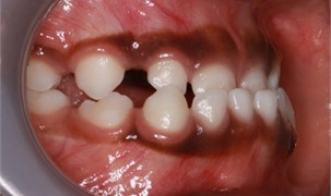 Sibling 1’s initial pictures: a) anterior view in maximum intercuspidation, b) manipulated position of the mandible, c) right-side view, d) left-side view, e) negative overjet