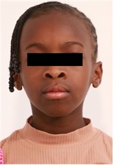 Follow-up pictures after 31 months: a)-d) intraoral pictures; e) panoramic X-ray, f)-i) facial pictures