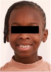 Follow-up pictures after 31 months: a)-d) intraoral pictures; e) panoramic X-ray, f)-i) facial pictures