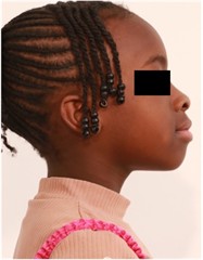 Follow-up pictures after 31 months: a)-d) intraoral pictures; e) panoramic X-ray, f)-i) facial pictures