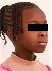 Follow-up pictures after 31 months: a)-d) intraoral pictures; e) panoramic X-ray, f)-i) facial pictures