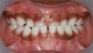 Preop pictures of Sibling 2: a)-c) intraoral pictures in maximum intercuspidation; d)-e) intraoral pictures of the manipulated position of the mandible as described in the text; f)-h) extraoral pictures