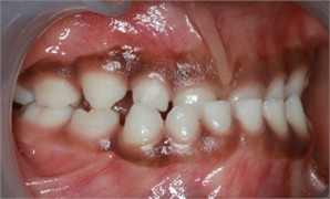 Preop pictures of Sibling 2: a)-c) intraoral pictures in maximum intercuspidation; d)-e) intraoral pictures of the manipulated position of the mandible as described in the text; f)-h) extraoral pictures
