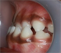 Preop pictures of Sibling 2: a)-c) intraoral pictures in maximum intercuspidation; d)-e) intraoral pictures of the manipulated position of the mandible as described in the text; f)-h) extraoral pictures
