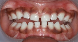 Preop pictures of Sibling 2: a)-c) intraoral pictures in maximum intercuspidation; d)-e) intraoral pictures of the manipulated position of the mandible as described in the text; f)-h) extraoral pictures