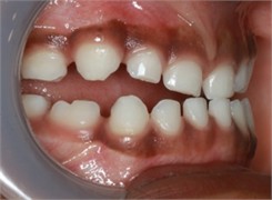 Preop pictures of Sibling 2: a)-c) intraoral pictures in maximum intercuspidation; d)-e) intraoral pictures of the manipulated position of the mandible as described in the text; f)-h) extraoral pictures
