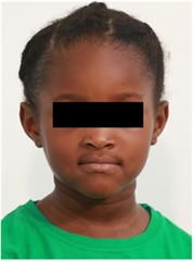 Preop pictures of Sibling 2: a)-c) intraoral pictures in maximum intercuspidation; d)-e) intraoral pictures of the manipulated position of the mandible as described in the text; f)-h) extraoral pictures