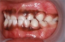 Sibling 1’s initial pictures: a) anterior view in maximum intercuspidation, b) manipulated position of the mandible, c) right-side view, d) left-side view, e) negative overjet