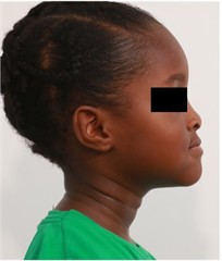 Preop pictures of Sibling 2: a)-c) intraoral pictures in maximum intercuspidation; d)-e) intraoral pictures of the manipulated position of the mandible as described in the text; f)-h) extraoral pictures