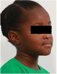 Preop pictures of Sibling 2: a)-c) intraoral pictures in maximum intercuspidation; d)-e) intraoral pictures of the manipulated position of the mandible as described in the text; f)-h) extraoral pictures