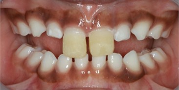 Intraoral pictures of Sibling 2: a) after the application of direct anterior tracks on day 1; b) one week follow-up; c) 4 weeks follow-up; d) 8 weeks follow-up