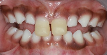 Intraoral pictures of Sibling 2: a) after the application of direct anterior tracks on day 1; b) one week follow-up; c) 4 weeks follow-up; d) 8 weeks follow-up