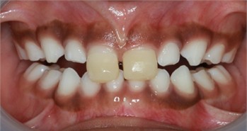 Intraoral pictures of Sibling 2: a) after the application of direct anterior tracks on day 1; b) one week follow-up; c) 4 weeks follow-up; d) 8 weeks follow-up