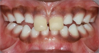 Intraoral pictures of Sibling 2: a) after the application of direct anterior tracks on day 1; b) one week follow-up; c) 4 weeks follow-up; d) 8 weeks follow-up