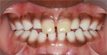 7 months follow-up pictures of Sibling 2: a)-d) Intraoral picture (Note the occlusal contact on the posterior teeth); e)-g) facial pictures