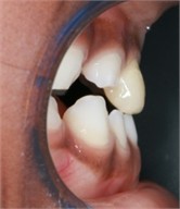7 months follow-up pictures of Sibling 2: a)-d) Intraoral picture (Note the occlusal contact on the posterior teeth); e)-g) facial pictures
