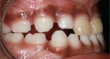 7 months follow-up pictures of Sibling 2: a)-d) Intraoral picture (Note the occlusal contact on the posterior teeth); e)-g) facial pictures