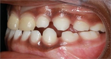 7 months follow-up pictures of Sibling 2: a)-d) Intraoral picture (Note the occlusal contact on the posterior teeth); e)-g) facial pictures