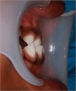 Sibling 1’s initial pictures: a) anterior view in maximum intercuspidation, b) manipulated position of the mandible, c) right-side view, d) left-side view, e) negative overjet