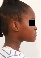 7 months follow-up pictures of Sibling 2: a)-d) Intraoral picture (Note the occlusal contact on the posterior teeth); e)-g) facial pictures
