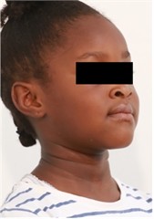 7 months follow-up pictures of Sibling 2: a)-d) Intraoral picture (Note the occlusal contact on the posterior teeth); e)-g) facial pictures