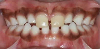 12 months follow-up pictures of Sibling 2: a)-d) intraoral picture; e)-g) facial pictures