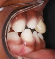 12 months follow-up pictures of Sibling 2: a)-d) intraoral picture; e)-g) facial pictures