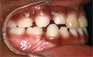 12 months follow-up pictures of Sibling 2: a)-d) intraoral picture; e)-g) facial pictures