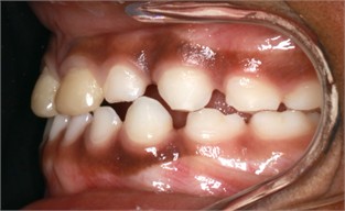 12 months follow-up pictures of Sibling 2: a)-d) intraoral picture; e)-g) facial pictures