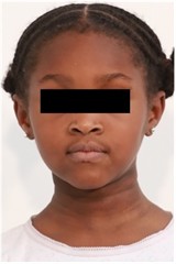 12 months follow-up pictures of Sibling 2: a)-d) intraoral picture; e)-g) facial pictures