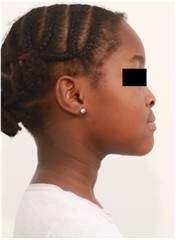 12 months follow-up pictures of Sibling 2: a)-d) intraoral picture; e)-g) facial pictures