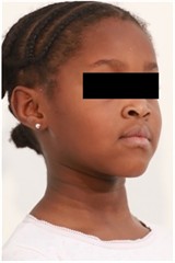 12 months follow-up pictures of Sibling 2: a)-d) intraoral picture; e)-g) facial pictures