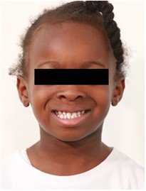 Sibling 1’s initial facial pictures