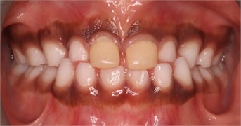 23 months follow-up pictures of Sibling 2: a)-d) intraoral picture; e)-g) facial pictures