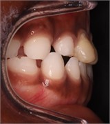 23 months follow-up pictures of Sibling 2: a)-d) intraoral picture; e)-g) facial pictures