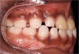 23 months follow-up pictures of Sibling 2: a)-d) intraoral picture; e)-g) facial pictures