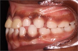 23 months follow-up pictures of Sibling 2: a)-d) intraoral picture; e)-g) facial pictures