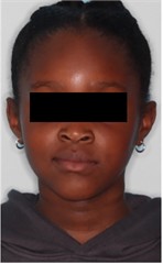 23 months follow-up pictures of Sibling 2: a)-d) intraoral picture; e)-g) facial pictures