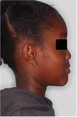23 months follow-up pictures of Sibling 2: a)-d) intraoral picture; e)-g) facial pictures