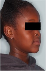 23 months follow-up pictures of Sibling 2: a)-d) intraoral picture; e)-g) facial pictures